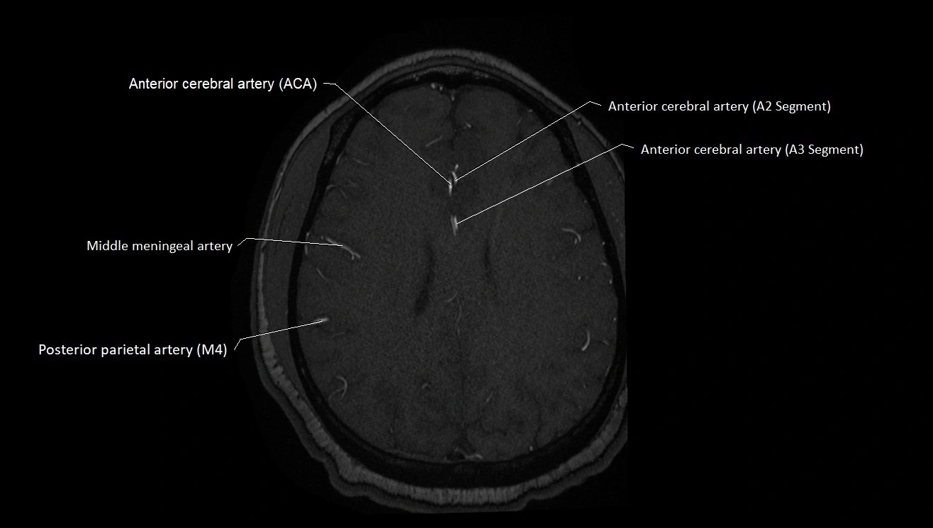 MRA brain (cerebral arteries) anatomy axial 3T image 41.webp
